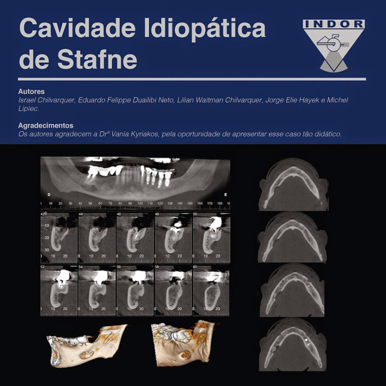 Cavidade Idiop Tica De Stafne Indor Instituto De Documenta O