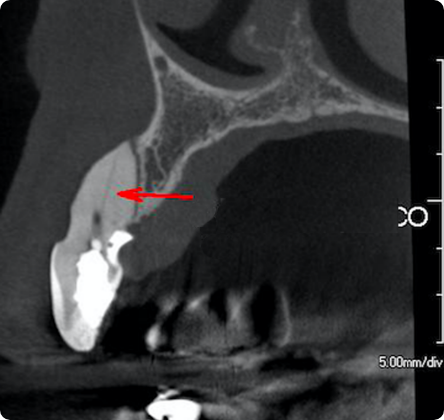 Tomografias de Ultra Resolução para Endodontia