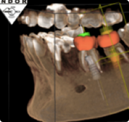 Tomografias de Ultra Resolução para Implante
