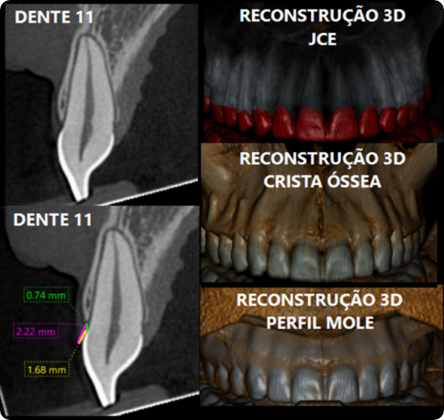 Tomografias de Ultra Resolução Periodontia