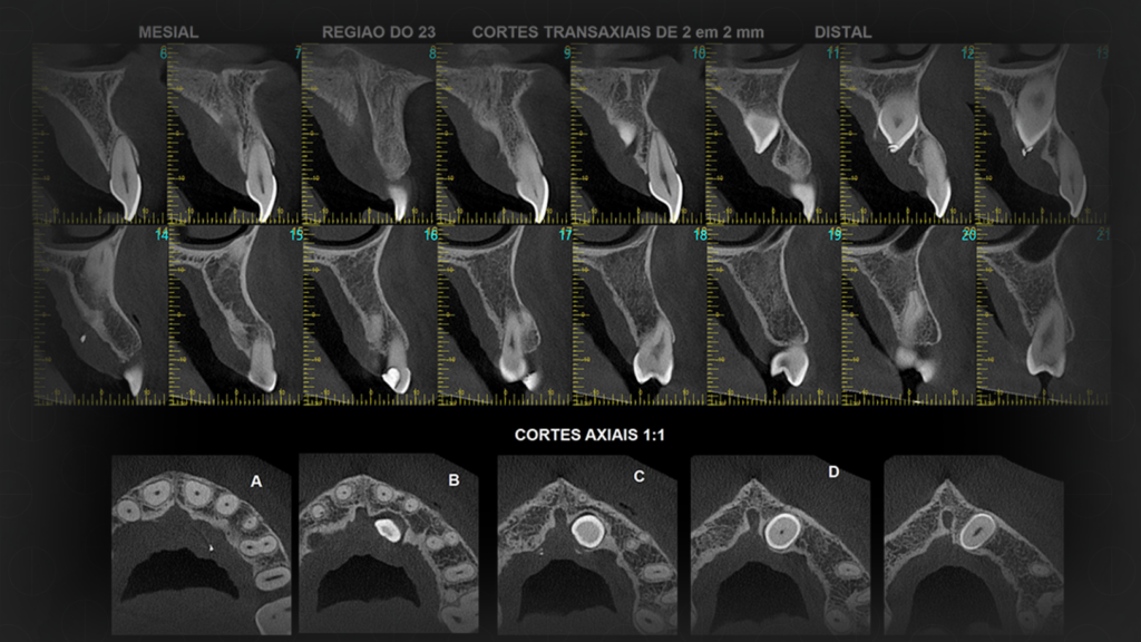 Tomografia Convencional e Tomografia Cone Beam