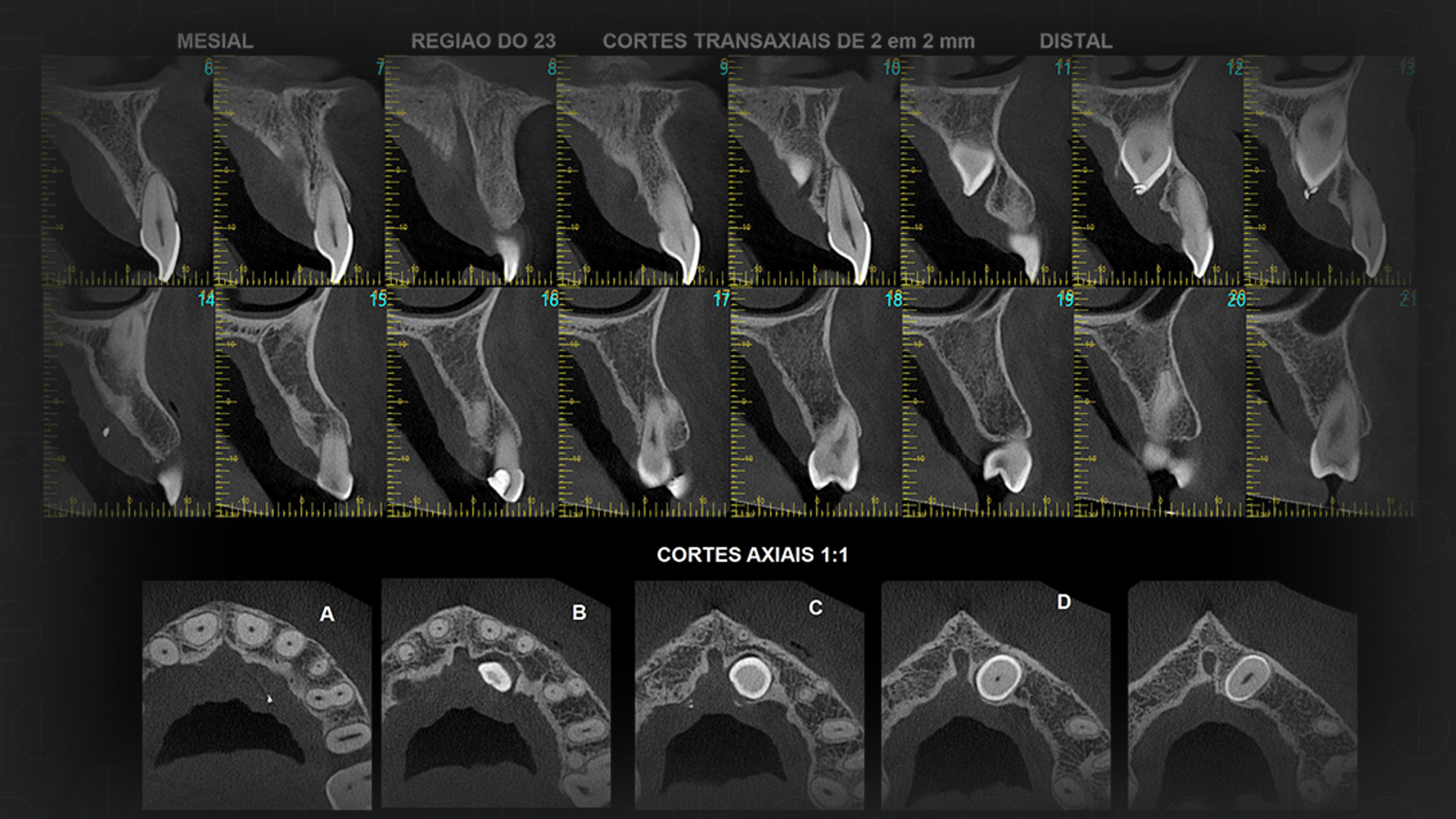 Tomografia Convencional e Tomografia Cone Beam